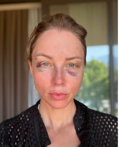 «Об этом никто не знал»: Полина Диброва показала страшные синяки в эфире у Малахова